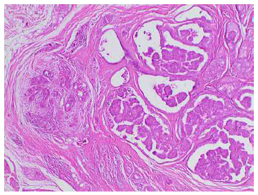 Carcinoma papilífero em cisto do ducto tireoglosso Relatos de Casos