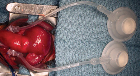 Braz J Cardiovasc Surg - The pulmonary vascular blood supply in