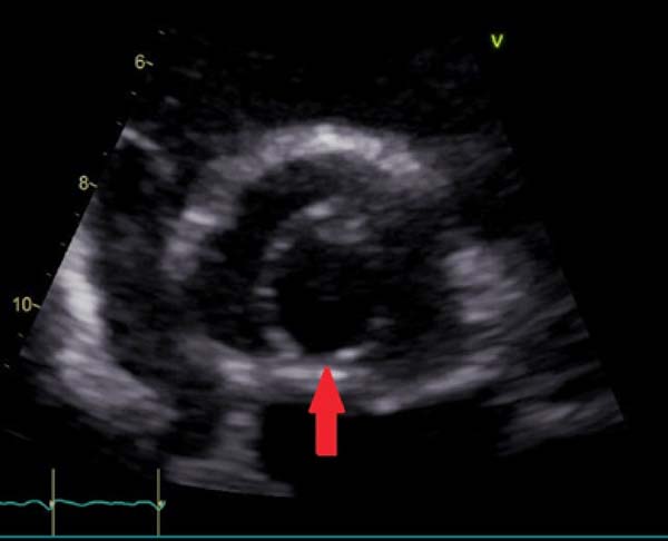 Braz J Cardiovasc Surg Conservative Treatment Of Unicuspid Aortic