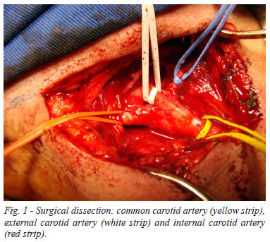 General anaesthesia versus local anaesthesia for carotid surgery