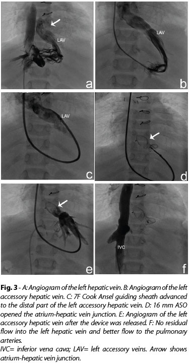 Braz J Cardiovasc Surg Major Intrahepatic Veno Venous Fistula After