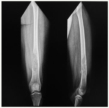 Brazilian Journal Of Oncology - Femoral intraosseous rhabdomyosarcoma