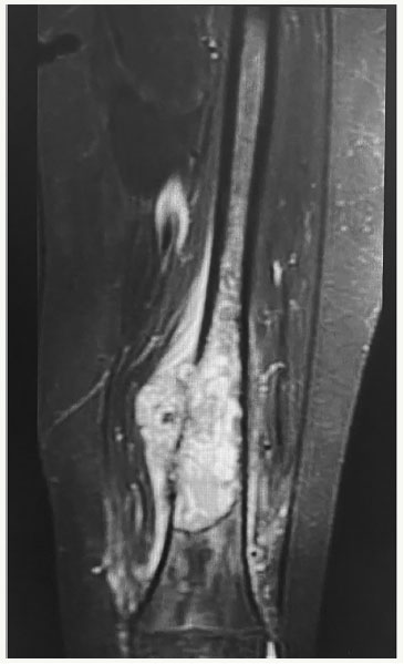 Brazilian Journal Of Oncology - Femoral intraosseous rhabdomyosarcoma ...