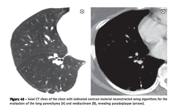 Jornal Brasileiro de Pneumologia - Intracavitary nodule