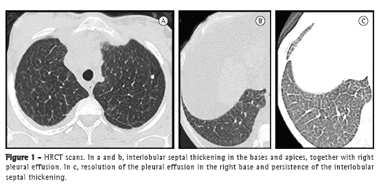 Niemann-Pick disease type B: HRCT assessment of pulmonary