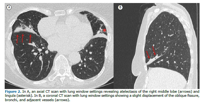 Jornal Brasileiro de Pneumologia - Intracavitary nodule