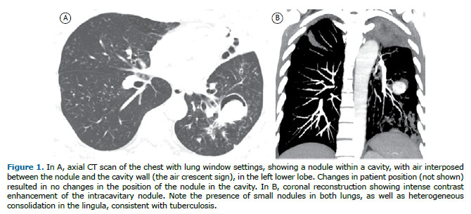 Jornal Brasileiro de Pneumologia - Intracavitary nodule