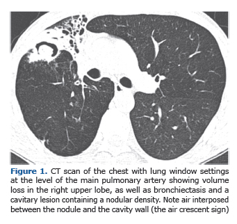 Jornal Brasileiro de Pneumologia - Intracavitary nodule