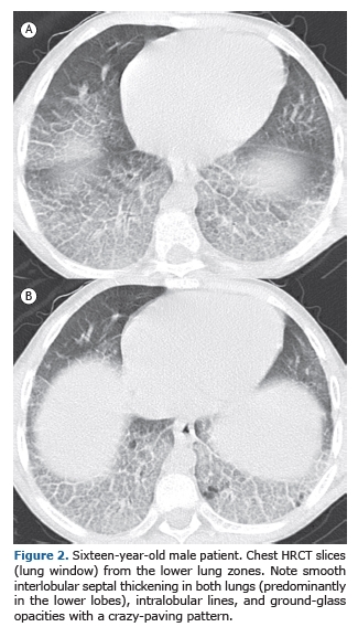 Niemann-Pick disease type B: HRCT assessment of pulmonary