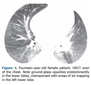 Niemann-Pick disease type B: HRCT assessment of pulmonary