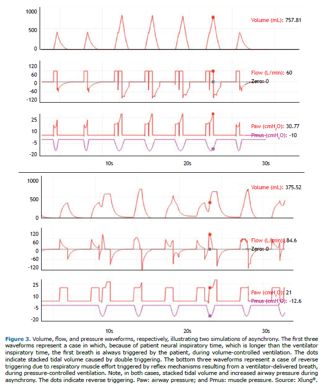 Jornal Brasileiro de Pneumologia - Patient-ventilator asynchrony