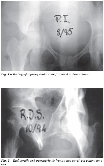 Revista Brasileira de Ortopedia - Acesso iliofemoral modificado