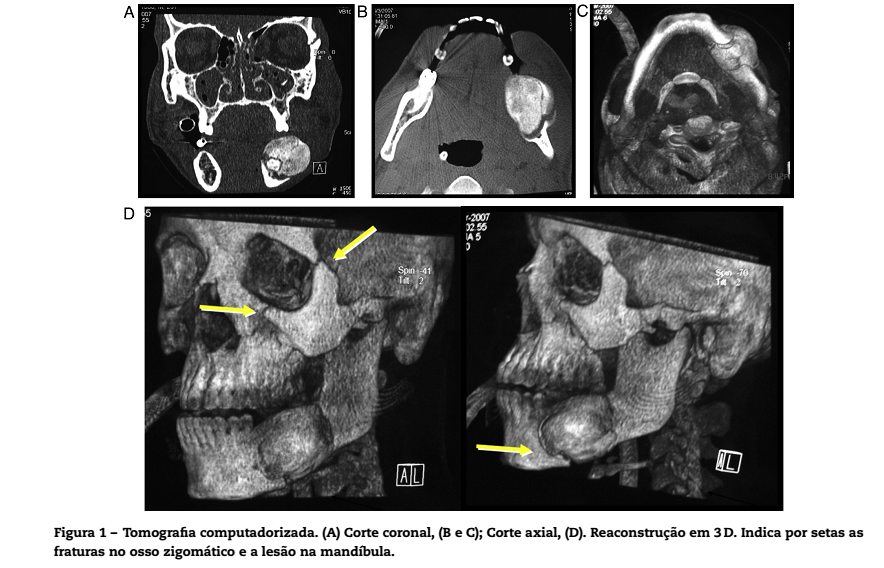 Osteoma de mandíbula: relato de caso