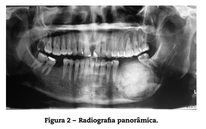 Osteoma de mandíbula: relato de caso