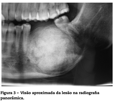 Osteoma de mandíbula: relato de caso