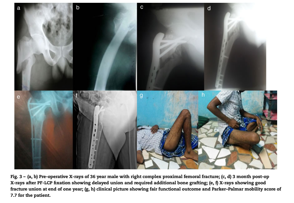 Revista Brasileira de Ortopedia - A retrospective analysis of surgically-treated complex proximal femur fractures with proximal femoral locking compression plate Revista Brasileira de Ortopedia - A retrospective analysis of surgically-treated complex proximal femur fractures with proximal femoral locking compression plate