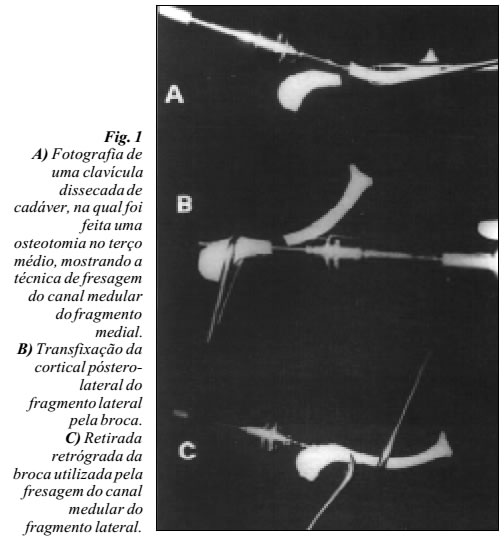 Revista Brasileira de Ortopedia Osteossíntese das fraturas do terço médio da clavícula com Revista Brasileira de Ortopedia Osteossíntese das fraturas do terço médio da clavícula com