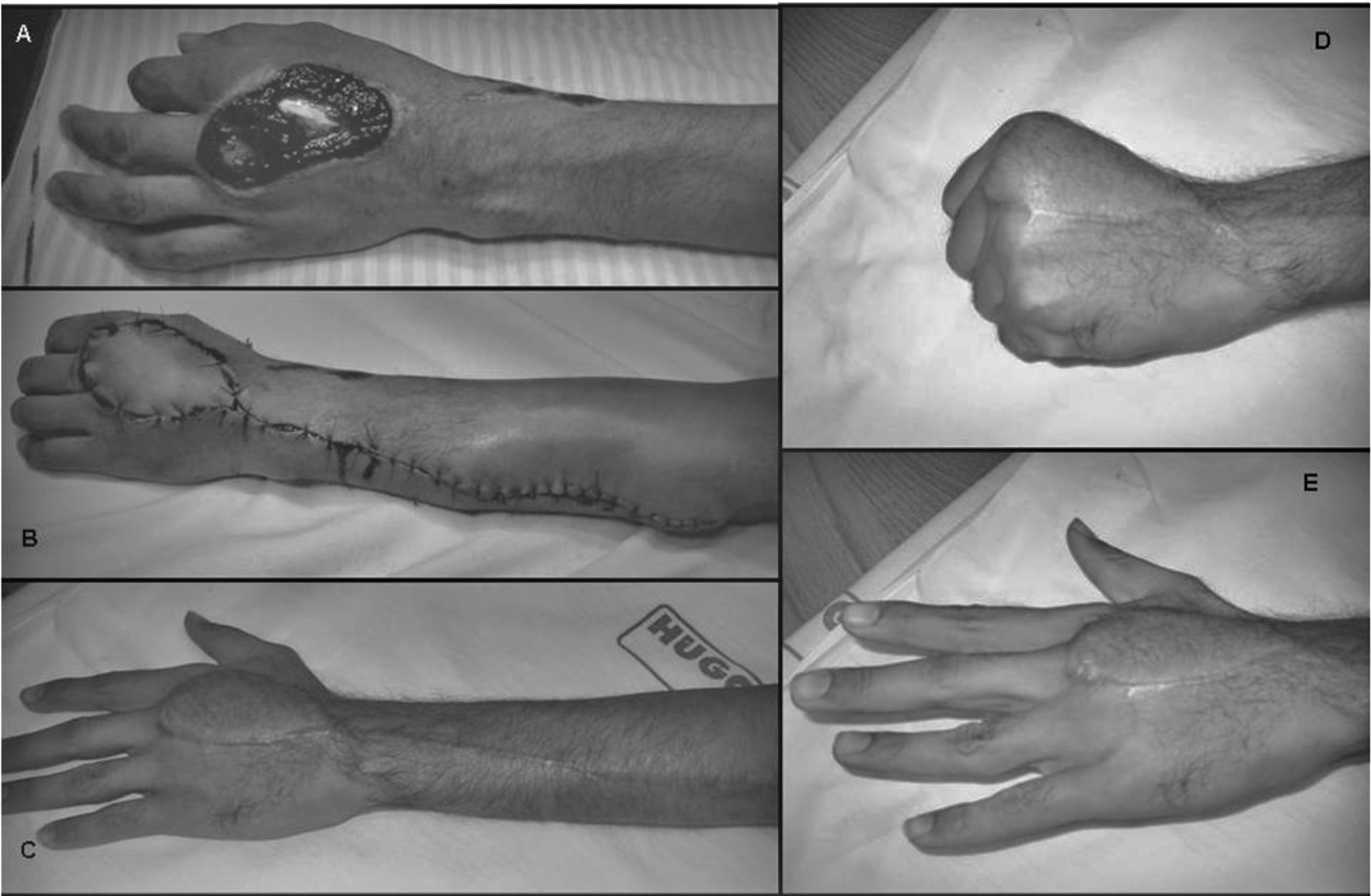 Revista Brasileira De Ortopedia Posterior Interbone Artery Flap For Covering Serious Forearm Wrist And Hand Injuries