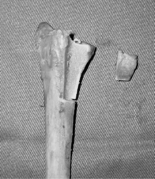 Revista Brasileira de Ortopedia WHAT IS THE BEST RADIOGRAPHIC VIEW