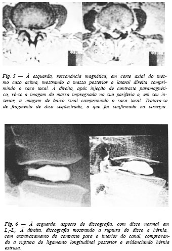 Motociclismul este dăunător în cazul herniei intervertebrale și varicelor?