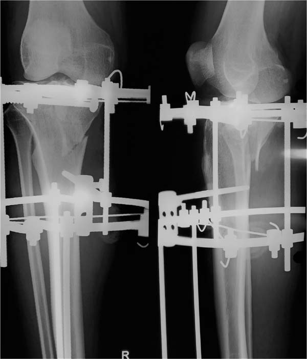 Ring external fixator (definitive) for Complete articular fracture,  fragmentary articular