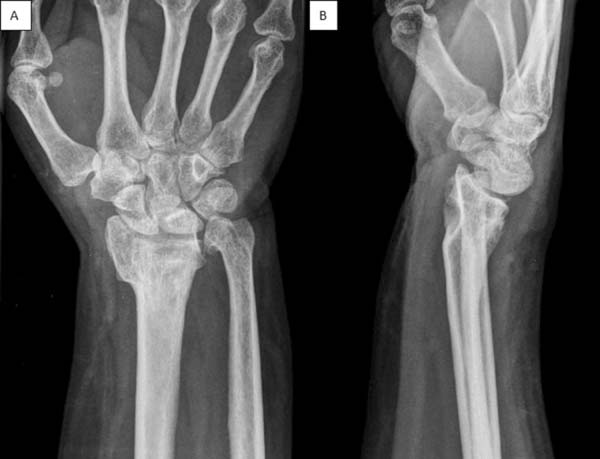 Revista Brasileira de Ortopedia - Treatment of Distal Radio Vicious  Consolidation: Corrective Osteotomy Through 3D Printing  Prototyping<sup>*</sup>