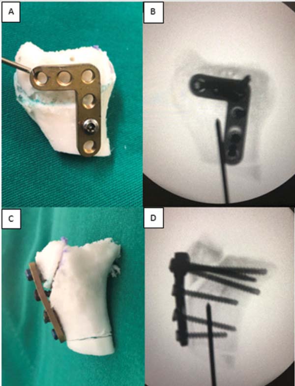 Revista Brasileira de Ortopedia - Treatment of Distal Radio Vicious  Consolidation: Corrective Osteotomy Through 3D Printing  Prototyping<sup>*</sup>