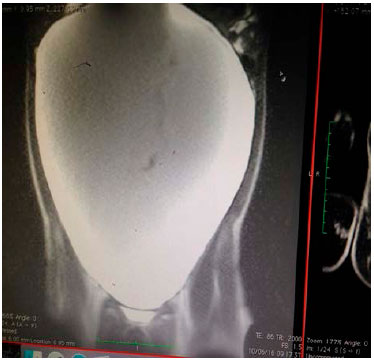 Como é o pós-operatório da cirurgia de câncer de ovário