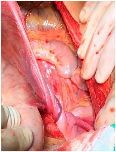 Como é o pós-operatório da cirurgia de câncer de ovário