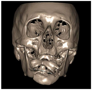 TRATAMENTO PARA Fratura Mandibular