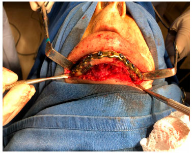 TRATAMENTO PARA Fratura Mandibular