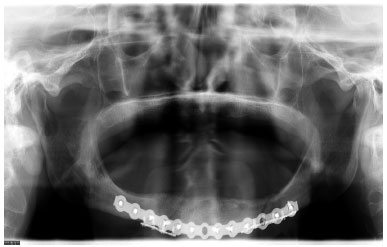 TRATAMENTO PARA Fratura Mandibular