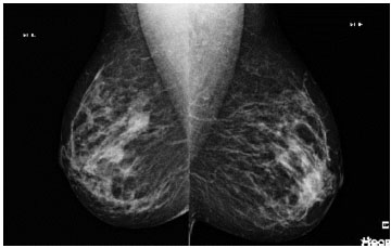 papiloma intraductal de mama tratamento