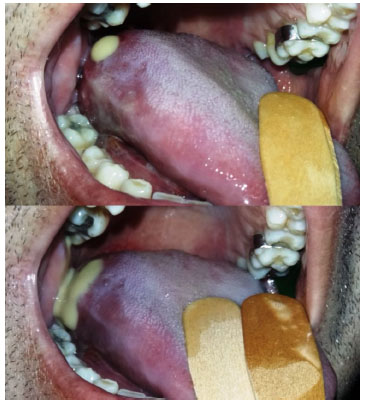 Inchaços embaixo da língua, o que podem ser? - Dentalis