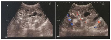 Teratoma de ovário pode se tornar câncer?