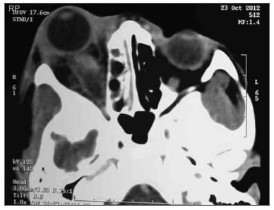 Celulite Pré-Septal (Periorbitária): o que é, como diagnosticar e tratar