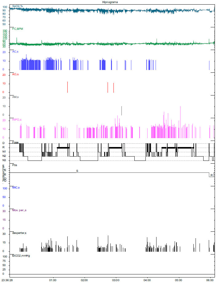 Sleep Science Treatment of sleep central apnea with noninvasive